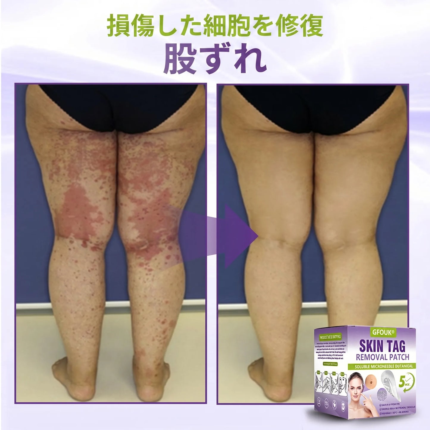 GFOUK® Soluble Microneedle Botanical Skin Tag Removal Patch