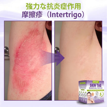 GFOUK® Soluble Microneedle Botanical Skin Tag Removal Patch