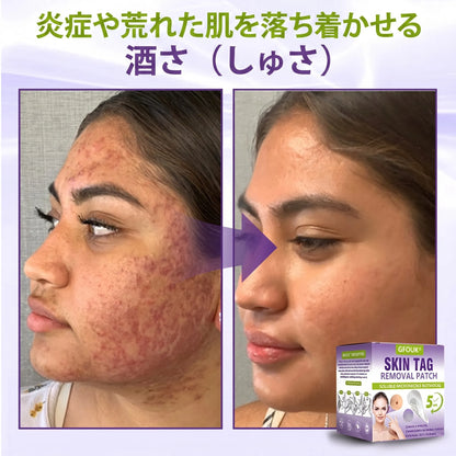 GFOUK® Soluble Microneedle Botanical Skin Tag Removal Patch