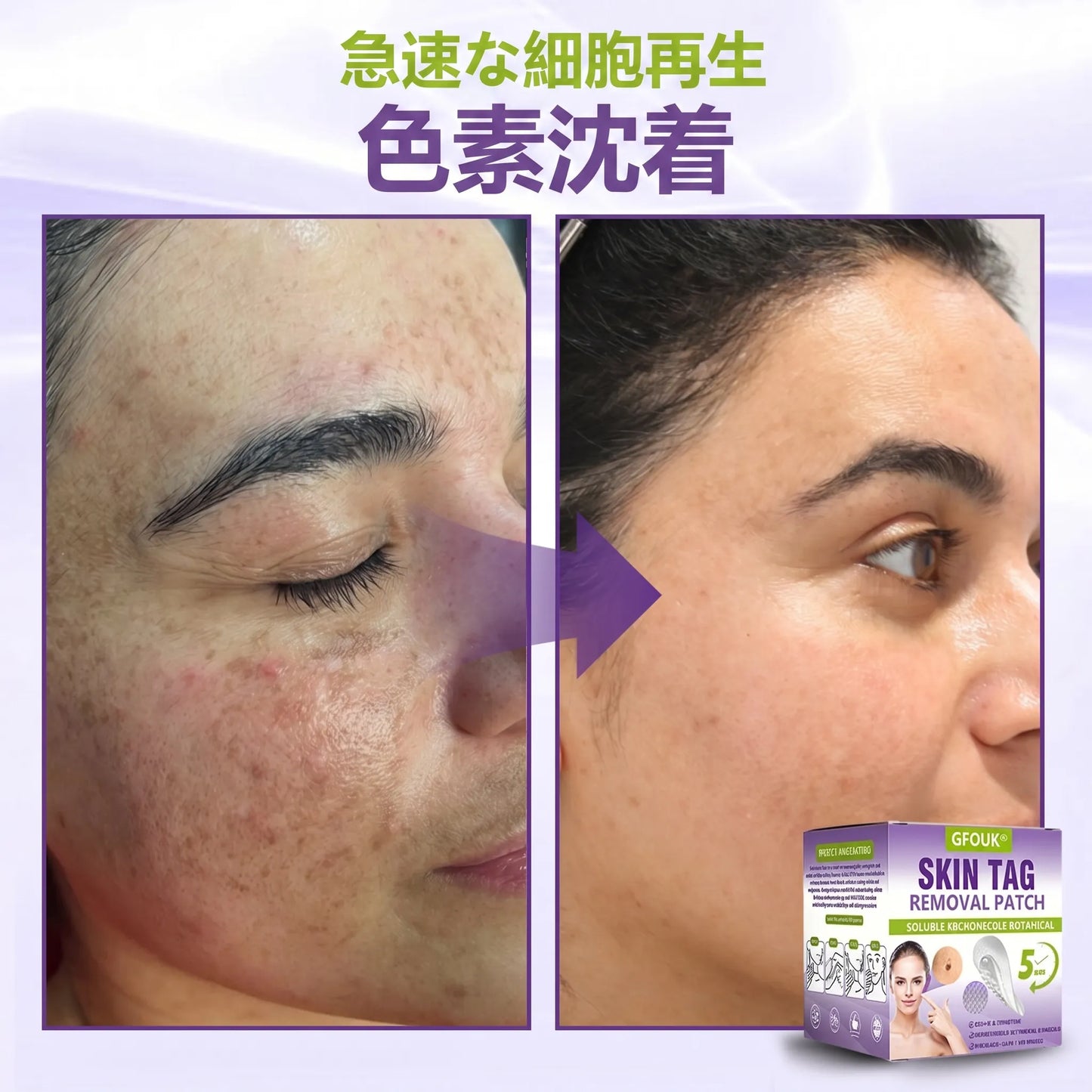 GFOUK® Soluble Microneedle Botanical Skin Tag Removal Patch