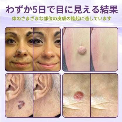 GFOUK® Soluble Microneedle Botanical Skin Tag Removal Patch