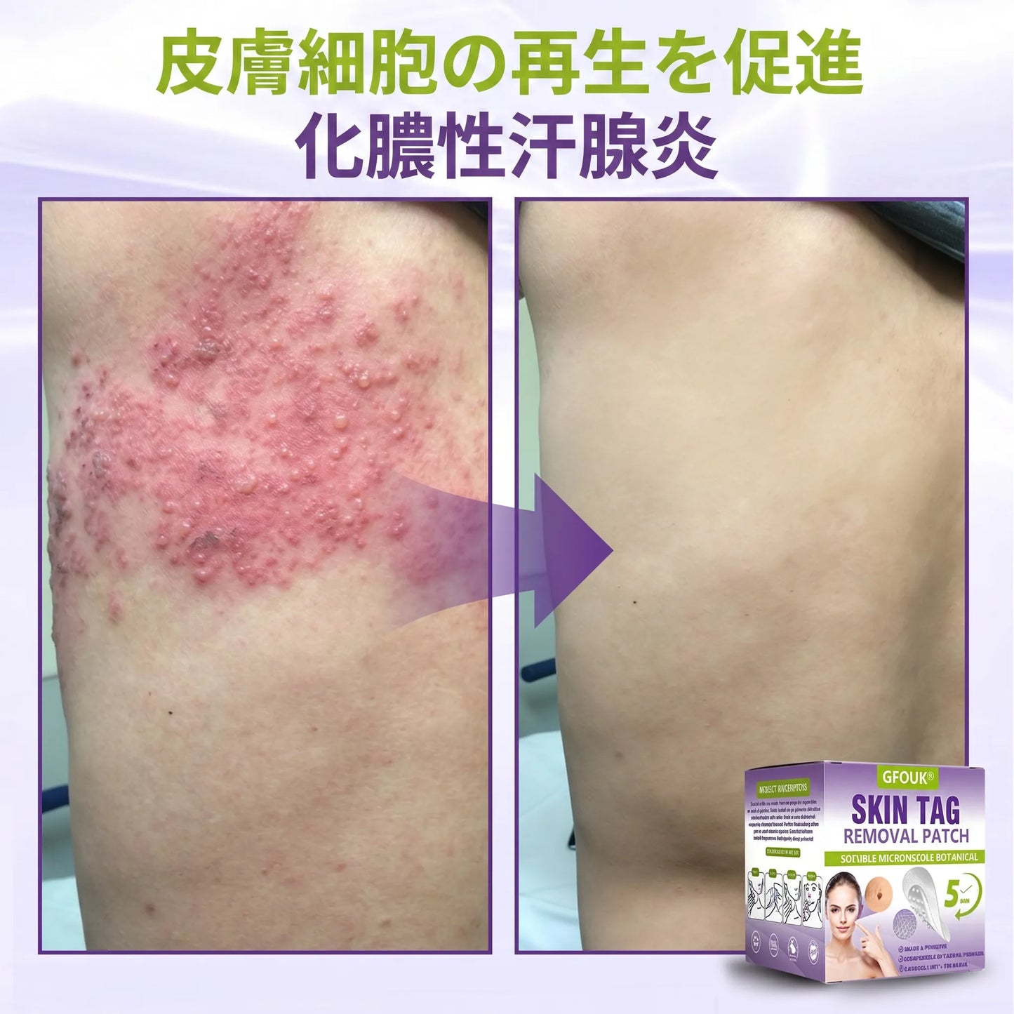 GFOUK® Soluble Microneedle Botanical Skin Tag Removal Patch